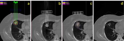 Clinical Outcome of CT-Guided Stereotactic Ablative Brachytherapy for Unresectable Early Non-Small Cell Lung Cancer: A Retrospective, Multicenter Study